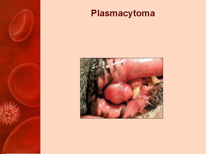 Plasmacytoma 