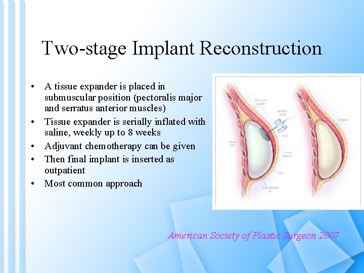 Two-stage Implant Reconstruction • A tissue expander is placed in submuscular position (pectoralis major