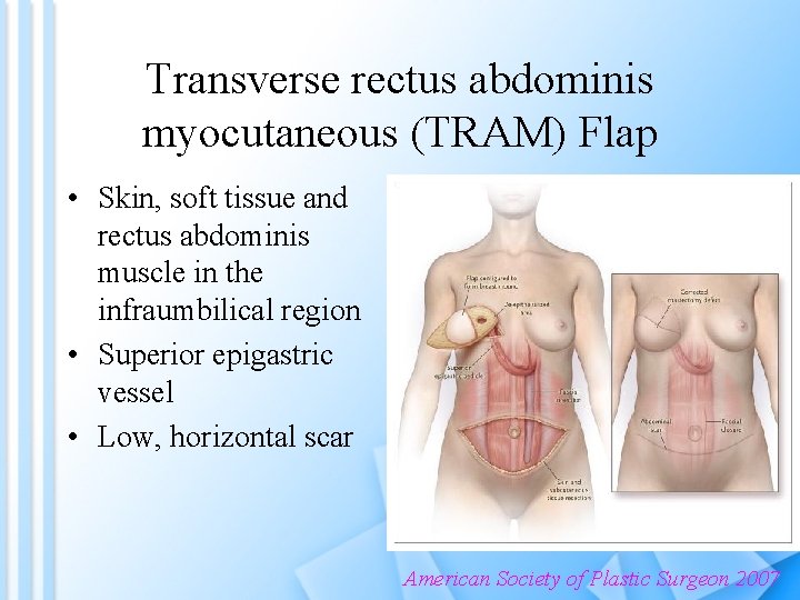 Transverse rectus abdominis myocutaneous (TRAM) Flap • Skin, soft tissue and rectus abdominis muscle