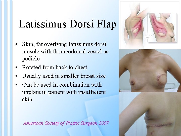 Latissimus Dorsi Flap • Skin, fat overlying latissimus dorsi muscle with thoracodorsal vessel as