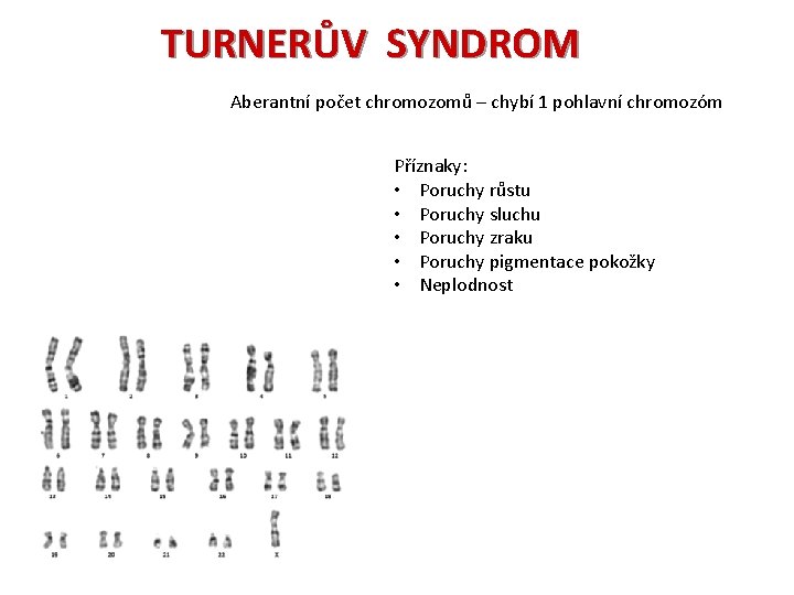 TURNERŮV SYNDROM Aberantní počet chromozomů – chybí 1 pohlavní chromozóm Příznaky: • Poruchy růstu
