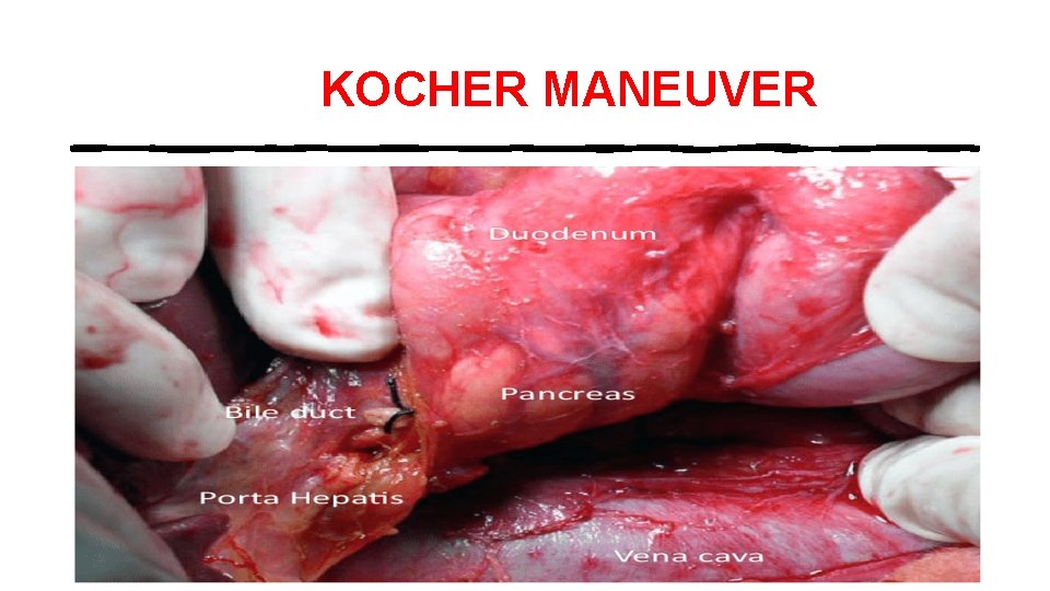 KOCHER MANEUVER 