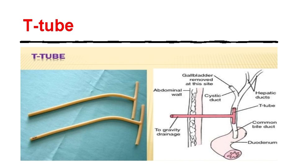 T-tube 