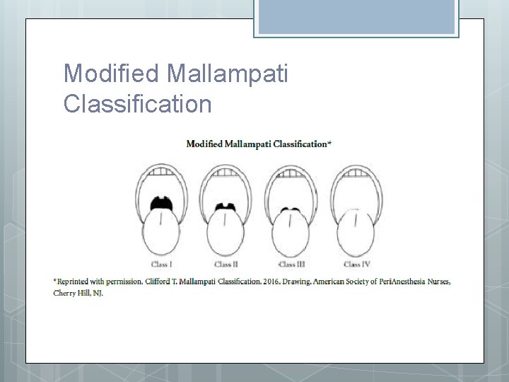 Modified Mallampati Classification 