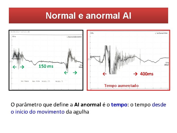 Normal e anormal AI ← → 150 ms ← → 400 ms Tempo aumentado