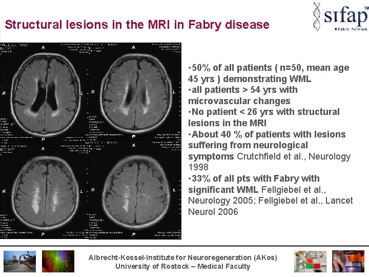 Structural lesions in the MRI in Fabry disease • 50% of all patients (
