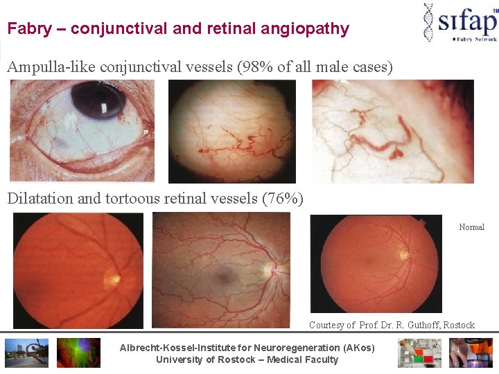 Fabry – conjunctival and retinal angiopathy Ampulla-like conjunctival vessels (98% of all male cases)