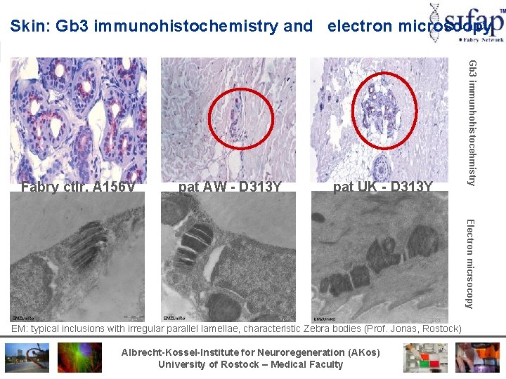 Skin: Gb 3 immunohistochemistry and electron microscopy pat AW - D 313 Y pat