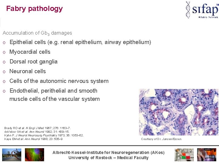 Fabry pathology Accumulation of Gb 3 damages o Epithelial cells (e. g. renal epithelium,