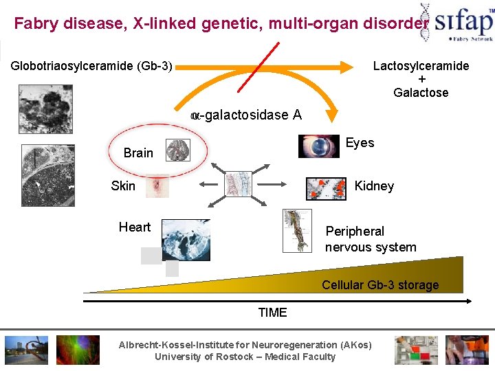 Fabry disease, X-linked genetic, multi-organ disorder Globotriaosylceramide (Gb-3) Lactosylceramide + Galactose -galactosidase A Eyes