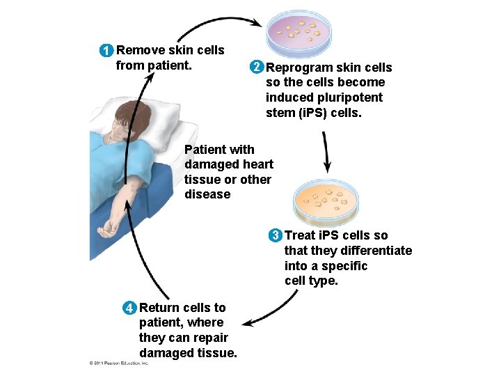 1 Remove skin cells from patient. 2 Reprogram skin cells so the cells become