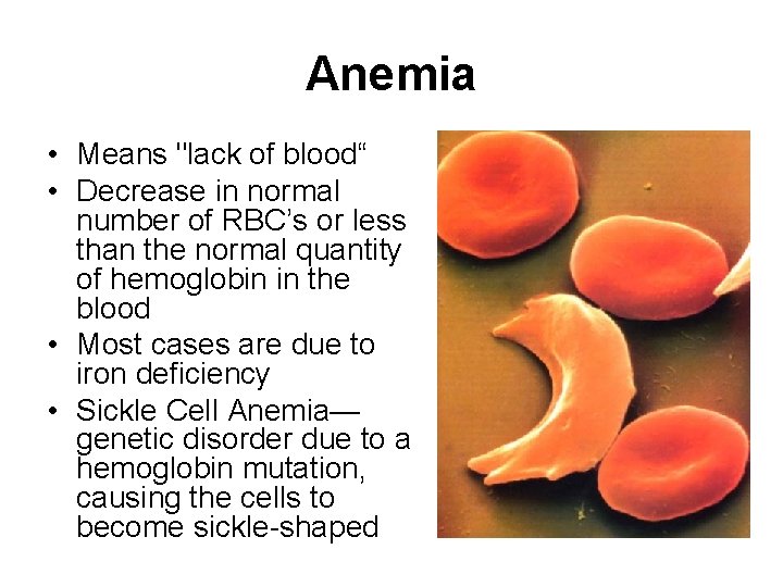 Anemia • Means "lack of blood“ • Decrease in normal number of RBC’s or