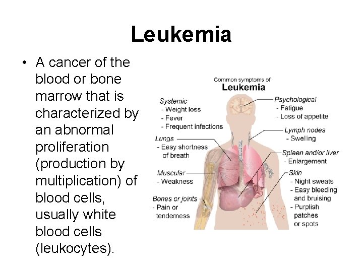 Leukemia • A cancer of the blood or bone marrow that is characterized by
