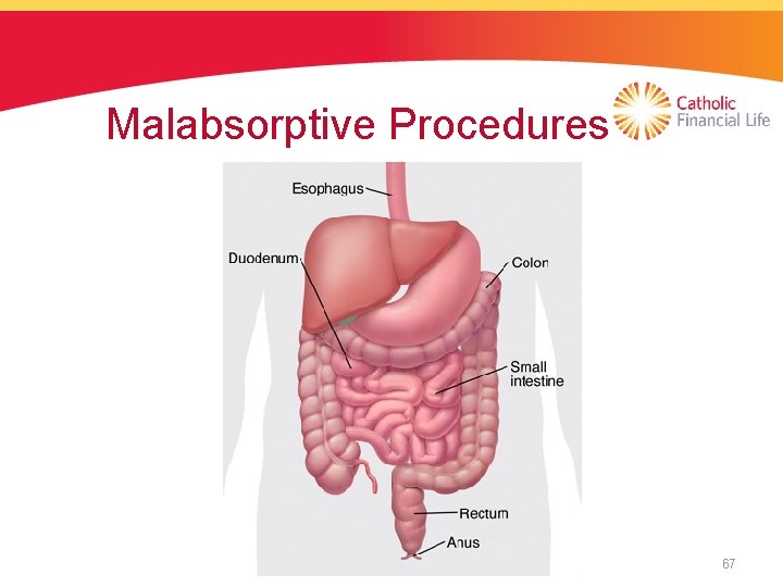 Malabsorptive Procedures 67 