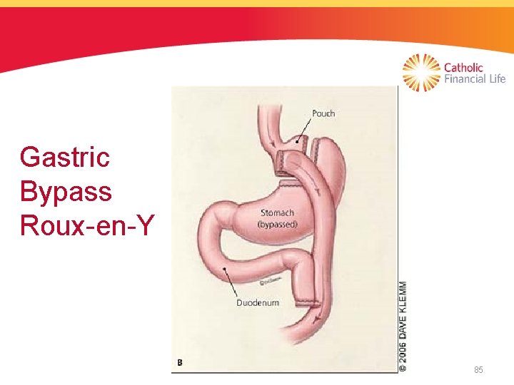 Gastric Bypass Roux-en-Y 85 