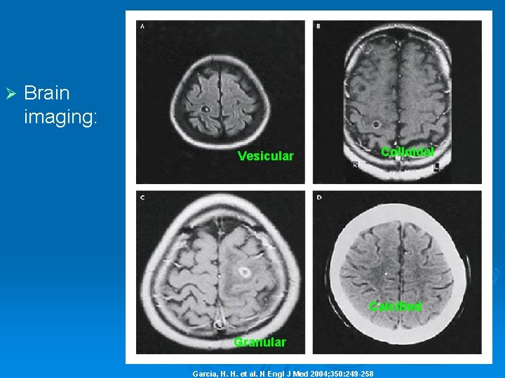 Ø Brain imaging: Colloidal Vesicular Calcified Granular Garcia, H. H. et al. N Engl
