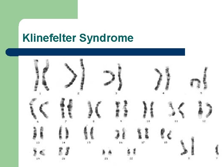 Klinefelter Syndrome 