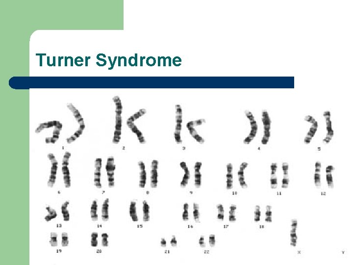 Turner Syndrome 
