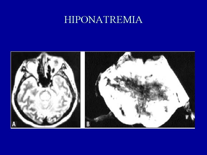 HIPONATREMIA 