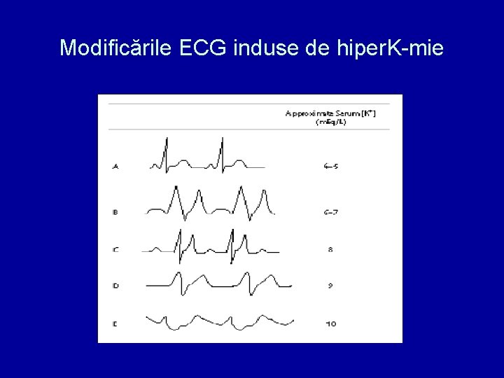 Modificările ECG induse de hiper. K-mie 