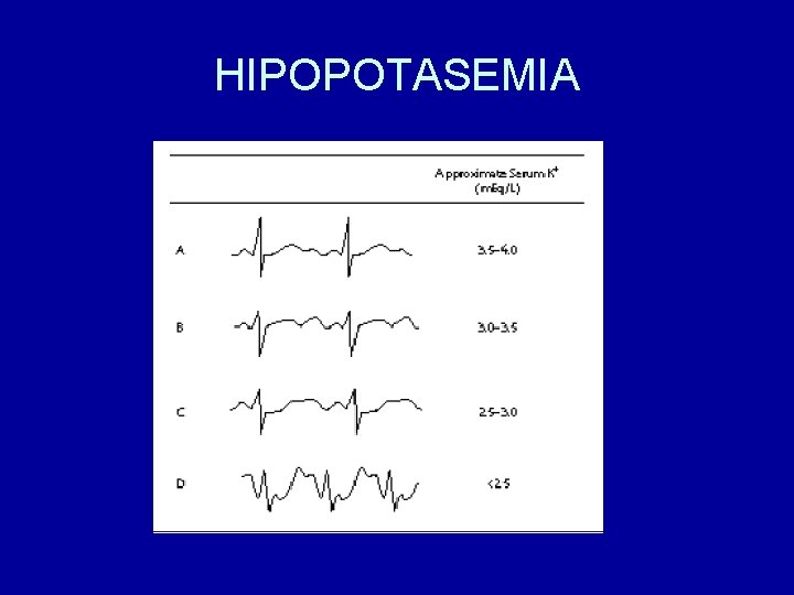 HIPOPOTASEMIA 