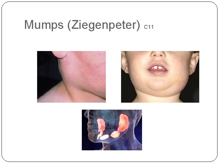 Mumps (Ziegenpeter) C 11 