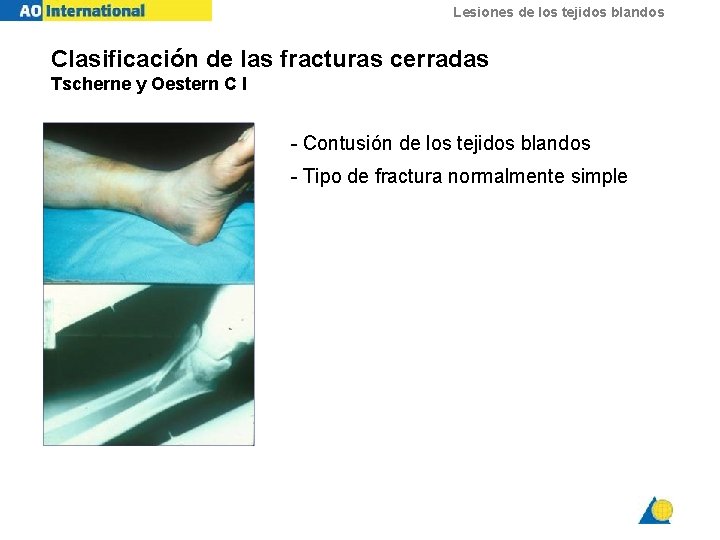 Lesiones de los tejidos blandos Clasificación de las fracturas cerradas Tscherne y Oestern C