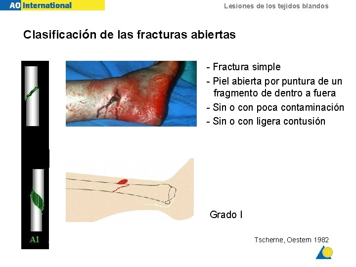 Lesiones de los tejidos blandos Clasificación de las fracturas abiertas - Fractura simple -