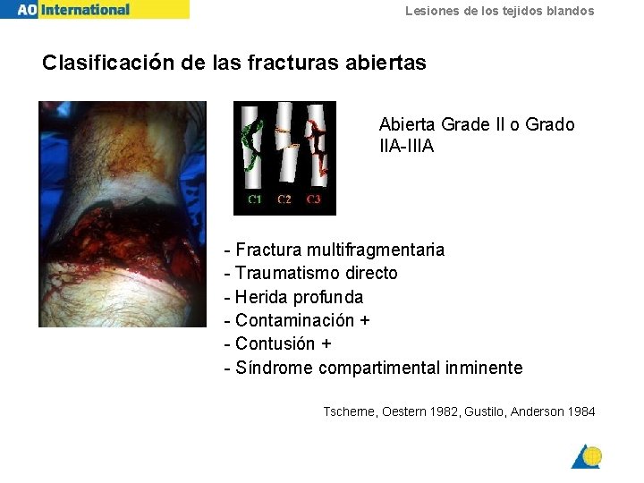 Lesiones de los tejidos blandos Clasificación de las fracturas abiertas Abierta Grade II o