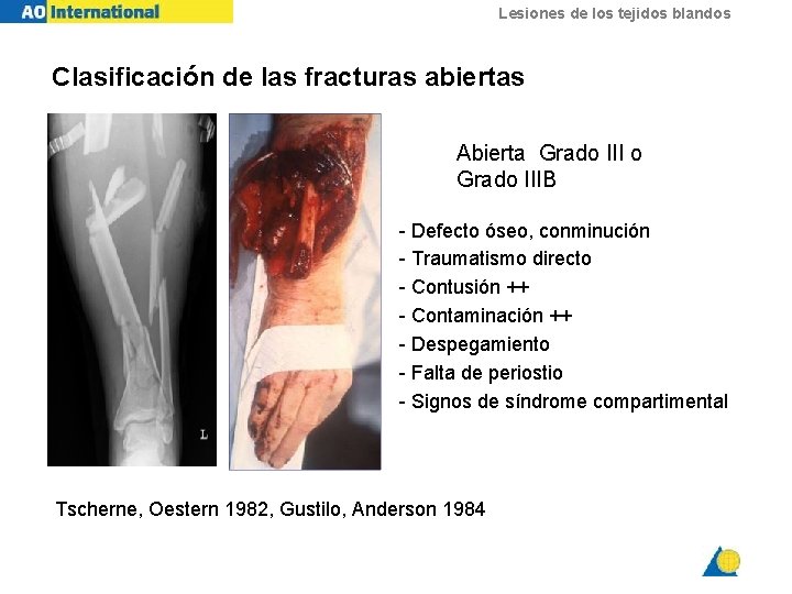 Lesiones de los tejidos blandos Clasificación de las fracturas abiertas Abierta Grado III o