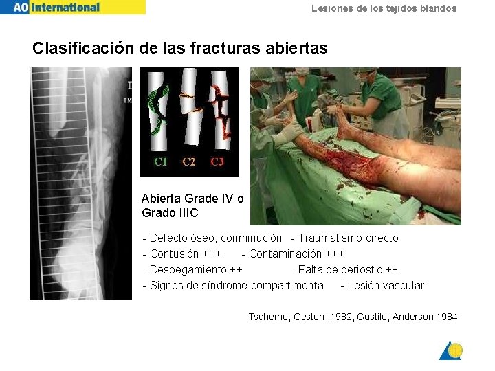 Lesiones de los tejidos blandos Clasificación de las fracturas abiertas Abierta Grade IV o