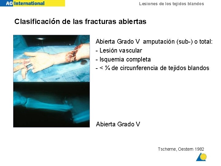 Lesiones de los tejidos blandos Clasificación de las fracturas abiertas Abierta Grado V amputación