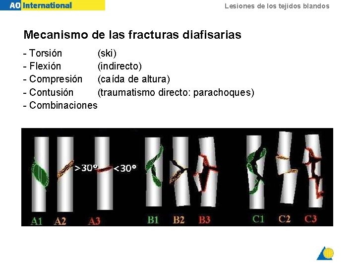 Lesiones de los tejidos blandos Mecanismo de las fracturas diafisarias - Torsión (ski) -