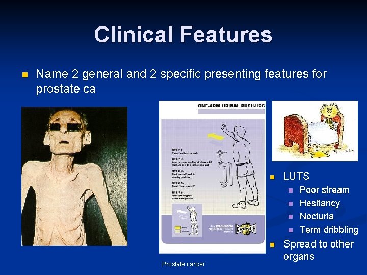 Clinical Features n Name 2 general and 2 specific presenting features for prostate ca