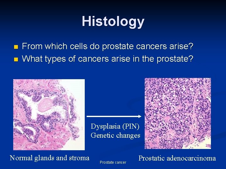 Histology n n From which cells do prostate cancers arise? What types of cancers