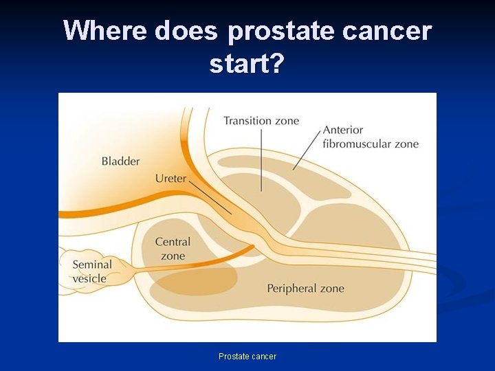 Where does prostate cancer start? Prostate cancer 