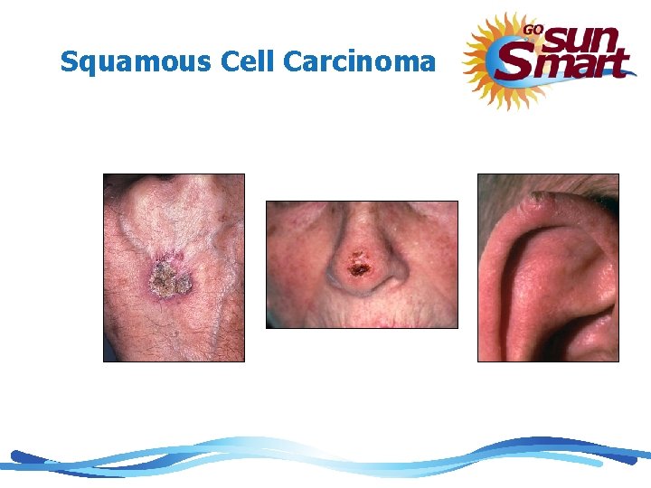 Squamous Cell Carcinoma 
