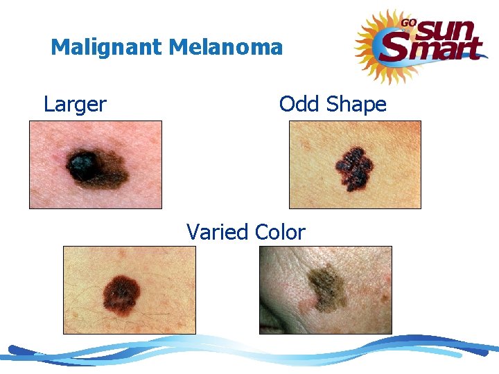 Malignant Melanoma Larger Odd Shape Varied Color 