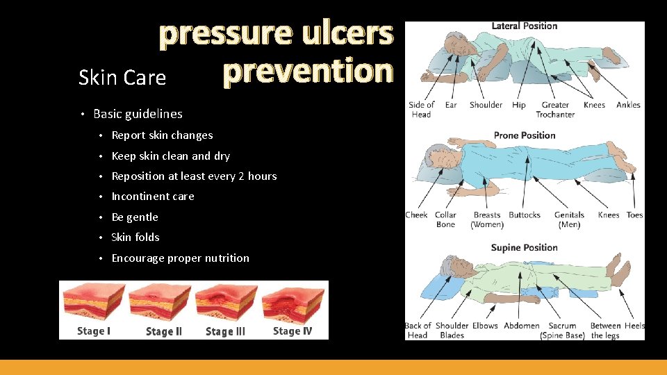 pressure ulcers prevention Skin Care • Basic guidelines • Report skin changes • Keep