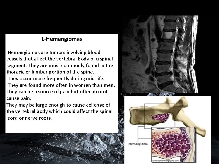 1 -Hemangiomas are tumors involving blood vessels that affect the vertebral body of a