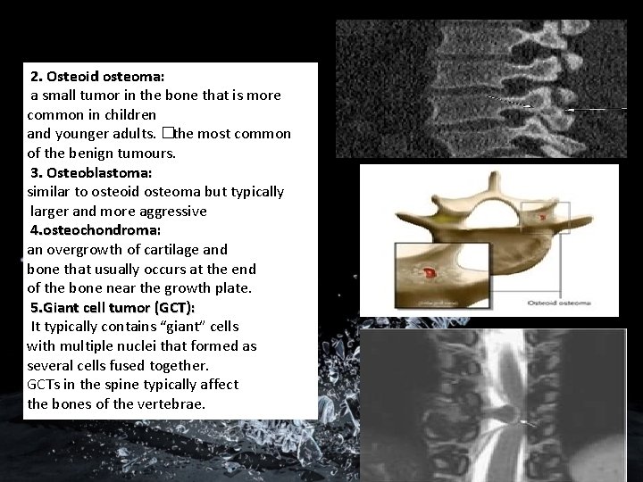 2. Osteoid osteoma: a small tumor in the bone that is more common in