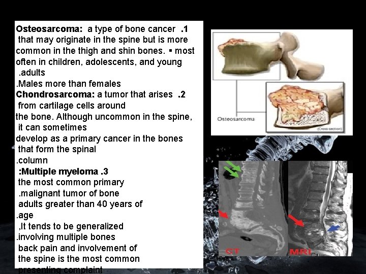 Osteosarcoma: a type of bone cancer. 1 that may originate in the spine but