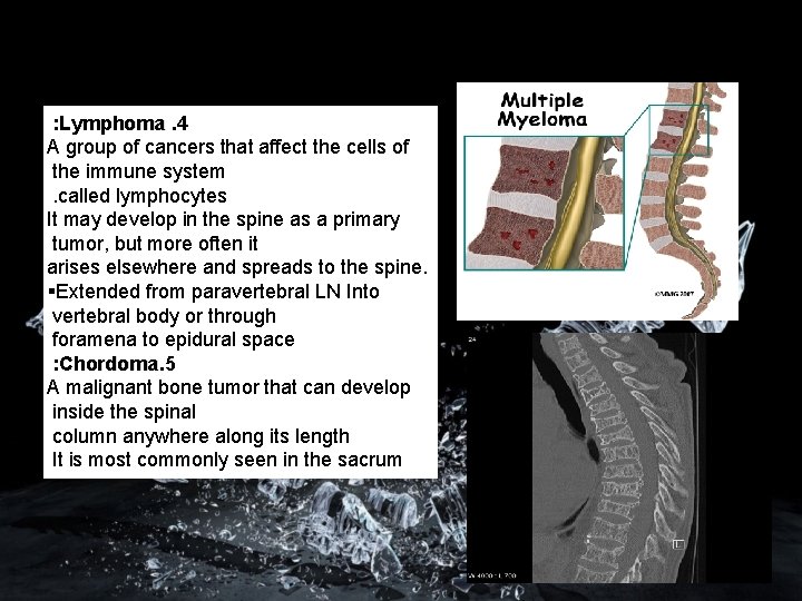 : Lymphoma. 4 A group of cancers that affect the cells of the immune