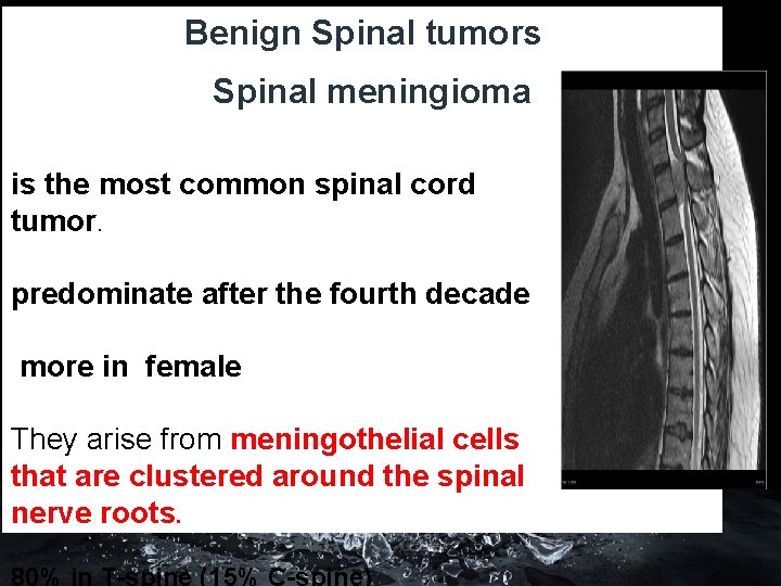 Benign Spinal tumors Spinal meningioma is the most common spinal cord tumor. predominate after