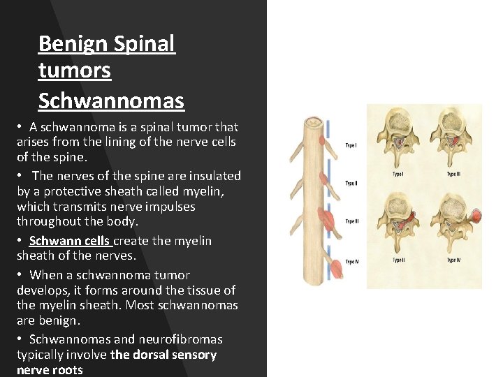 Benign Spinal tumors Schwannomas • A schwannoma is a spinal tumor that arises from