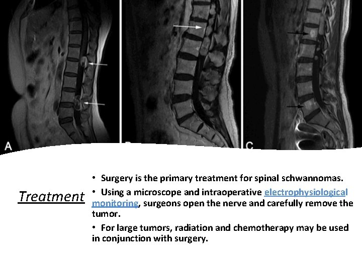 Treatment • Surgery is the primary treatment for spinal schwannomas. • Using a microscope