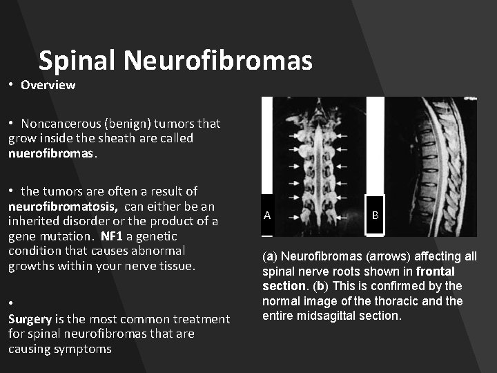 Spinal Neurofibromas • Overview • Noncancerous (benign) tumors that grow inside the sheath are