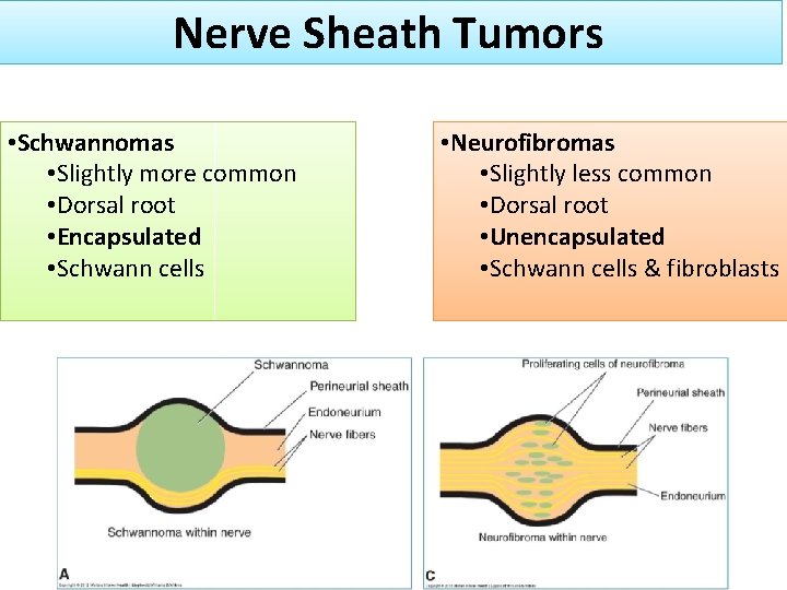 Nerve Sheath Tumors • Schwannomas • Slightly more common • Dorsal root • Encapsulated