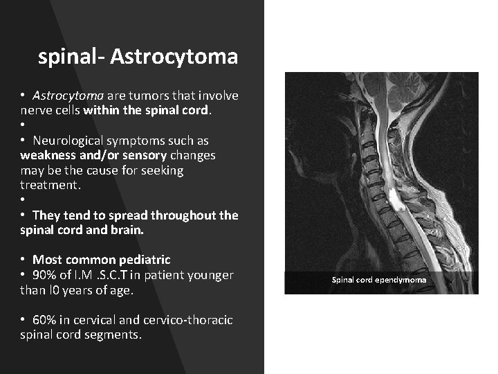 spinal- Astrocytoma • Astrocytoma are tumors that involve nerve cells within the spinal cord.