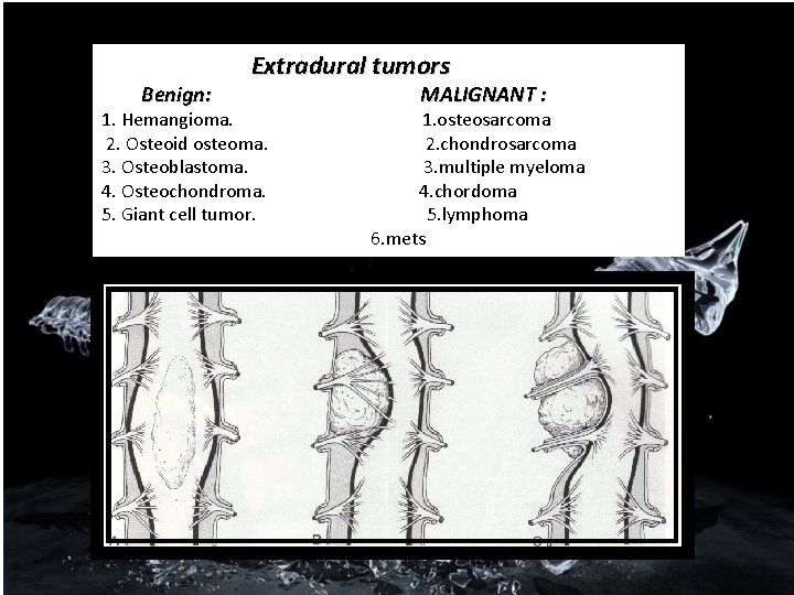 Benign: Extradural tumors 1. Hemangioma. 2. Osteoid osteoma. 3. Osteoblastoma. 4. Osteochondroma. 5. Giant